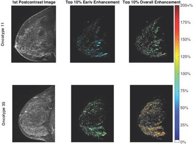 Background Parenchymal Enhancement on Breast MRI as a Prognostic Surrogate: Correlation With Breast Cancer Oncotype Dx Score